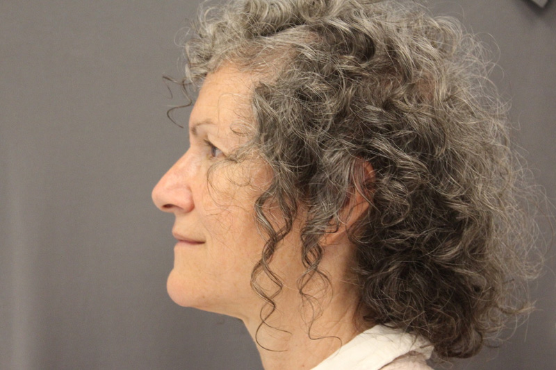 Upper Eye Lift Before & After Image
