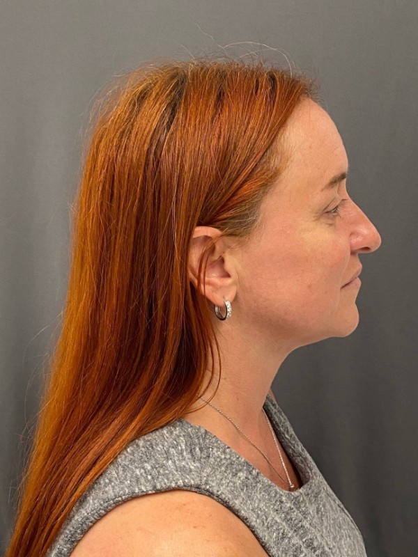 Facelift Before & After Image