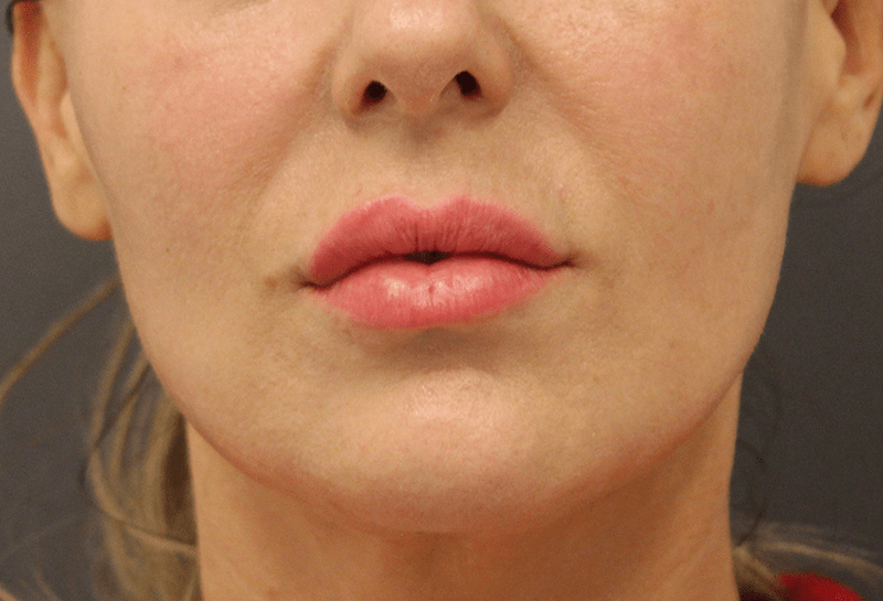 Lip Lift Before & After Image