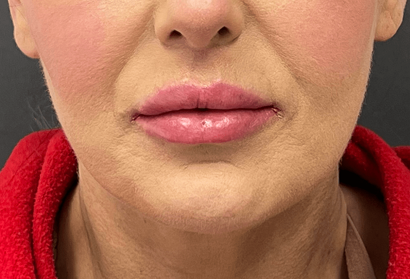 Lip Lift Before & After Image