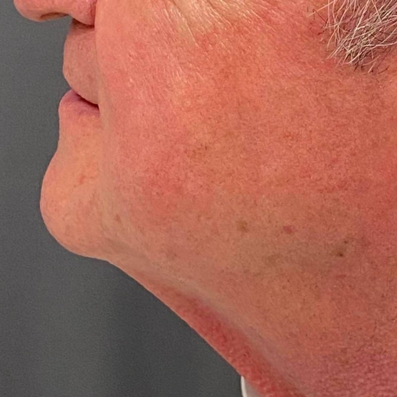 Neck Lift Before & After Image