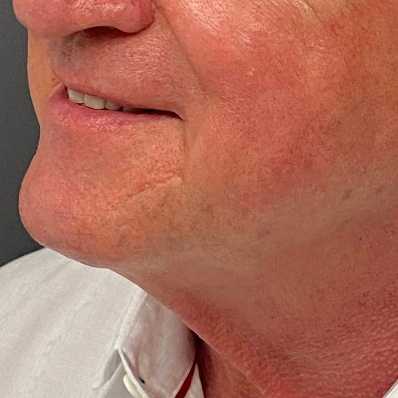 Neck Lift Before & After Image