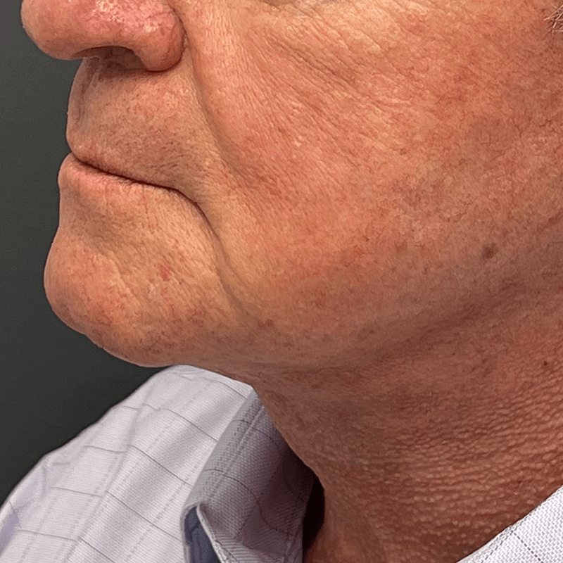 Neck Lift Before & After Image