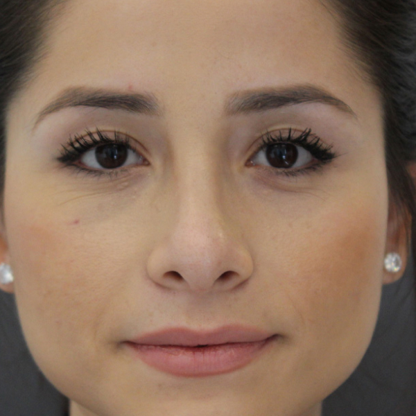 Rhinoplasty Before & After Image