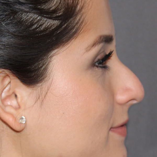 Rhinoplasty Before & After Image