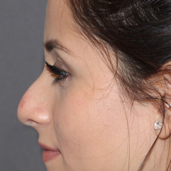 Rhinoplasty Before & After Image