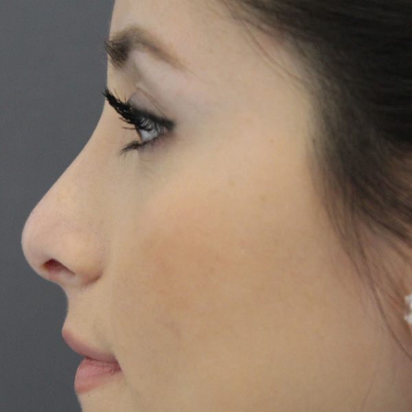 Rhinoplasty Before & After Image