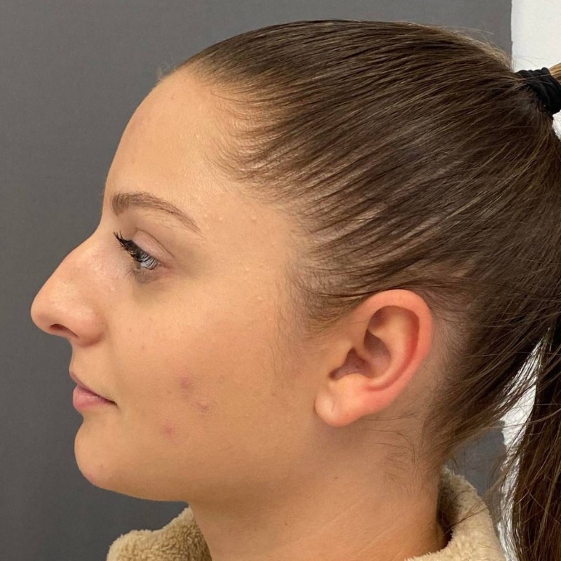 Rhinoplasty Before & After Image