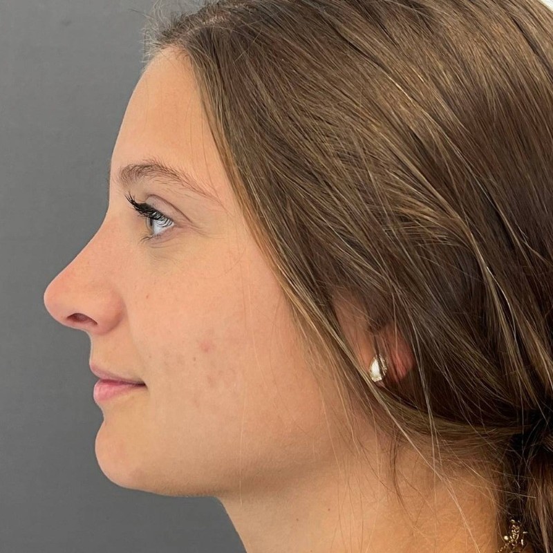 Rhinoplasty Before & After Image