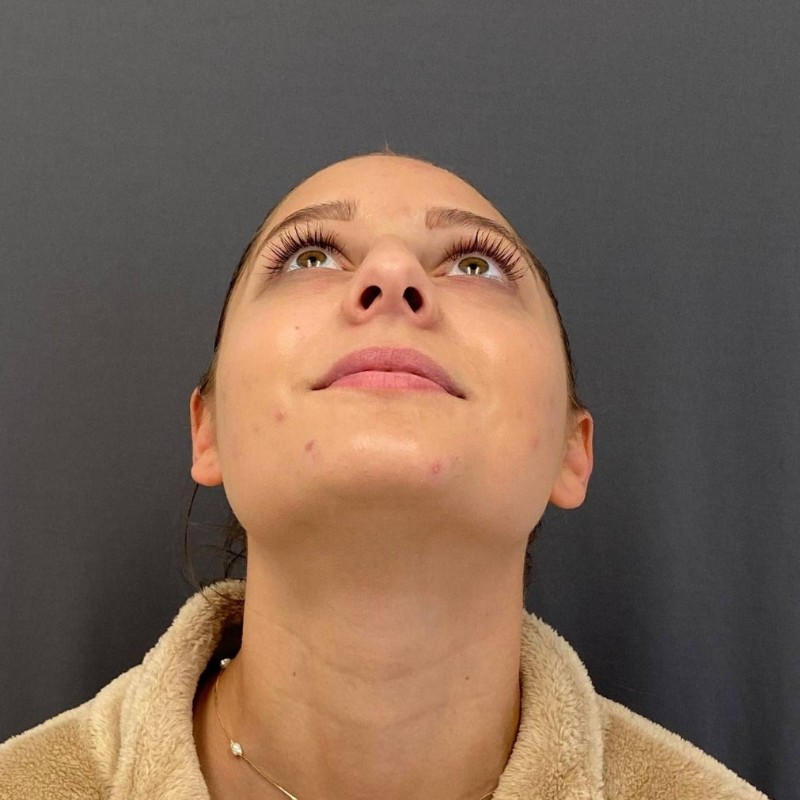 Rhinoplasty Before & After Image