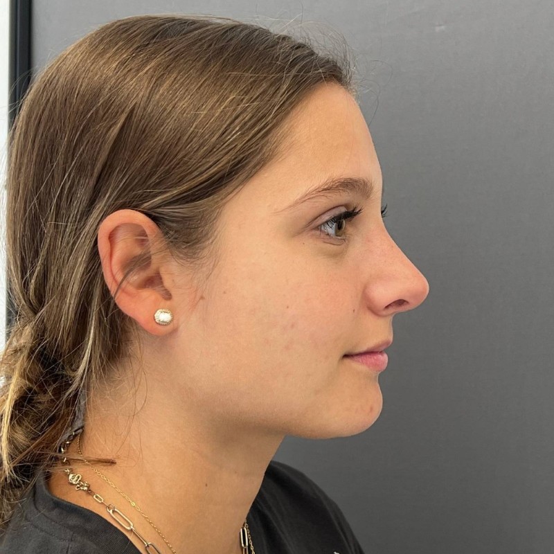 Rhinoplasty Before & After Image