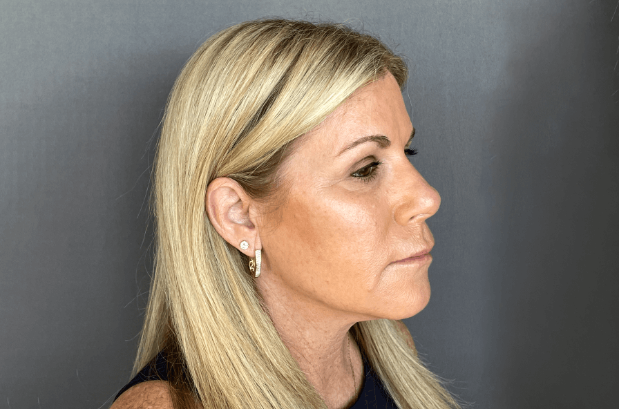 Upper Eye Lift Before & After Image