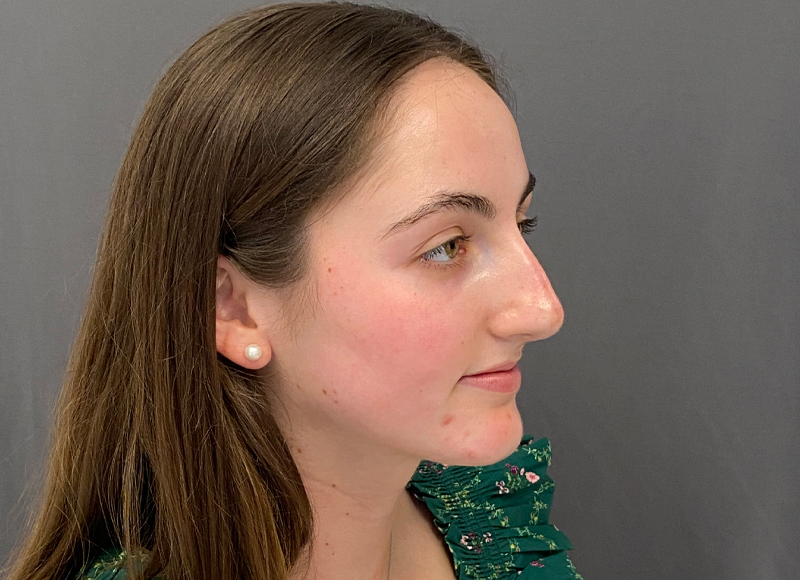 Liquid Rhinoplasty Before & After Image