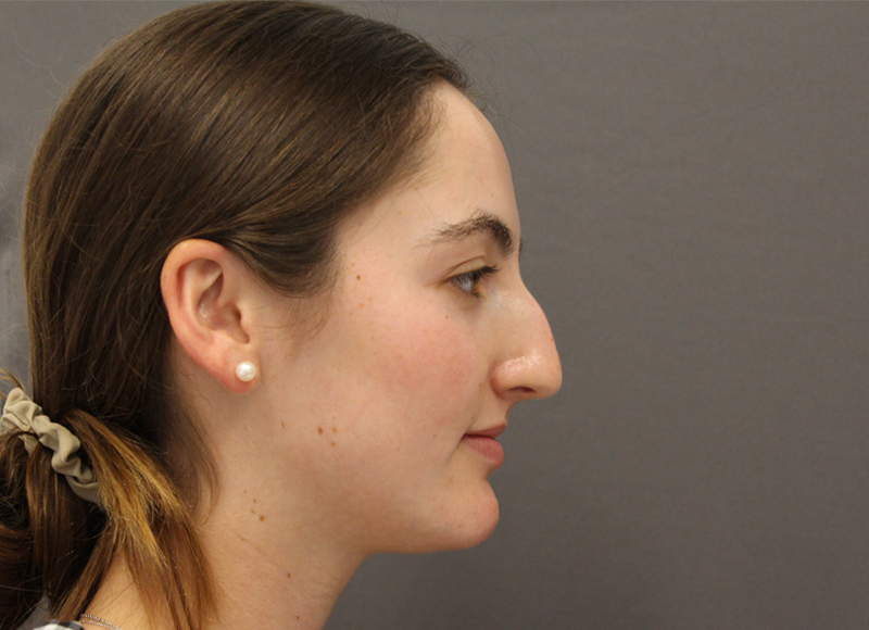 Liquid Rhinoplasty Before & After Image