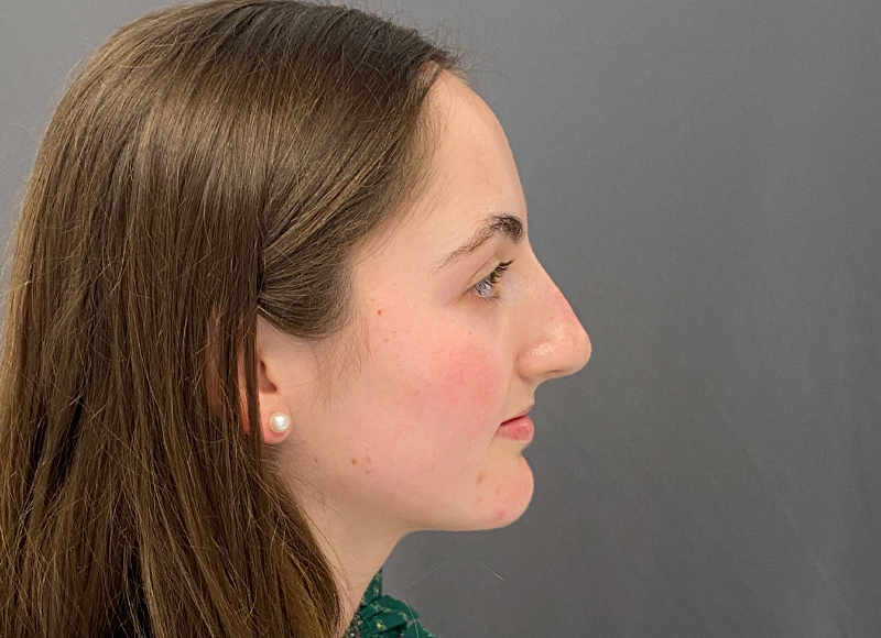 Liquid Rhinoplasty Before & After Image