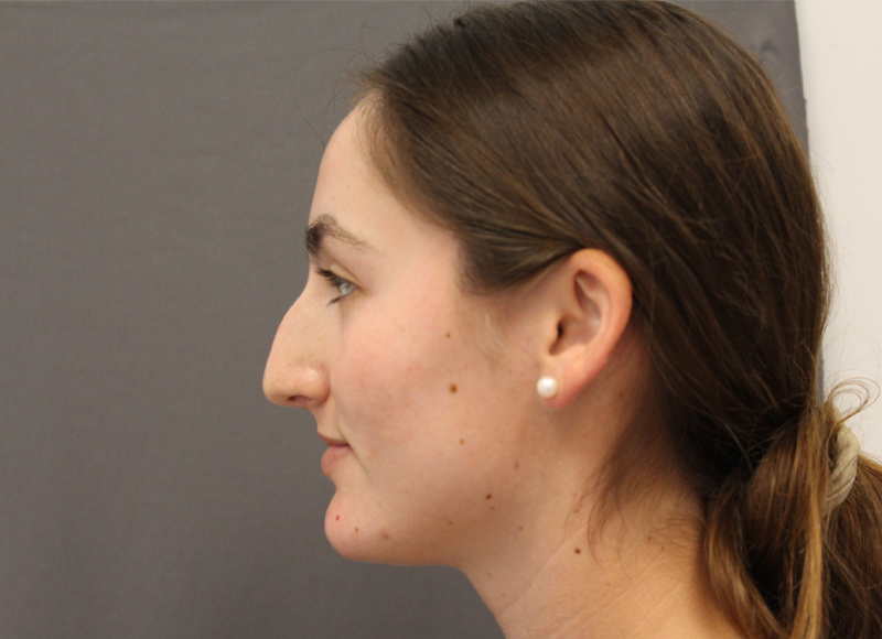 Liquid Rhinoplasty Before & After Image