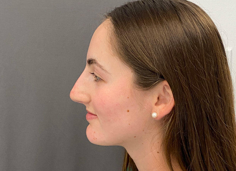 Liquid Rhinoplasty Before & After Image